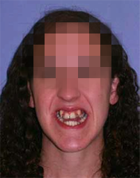 implantes dentales